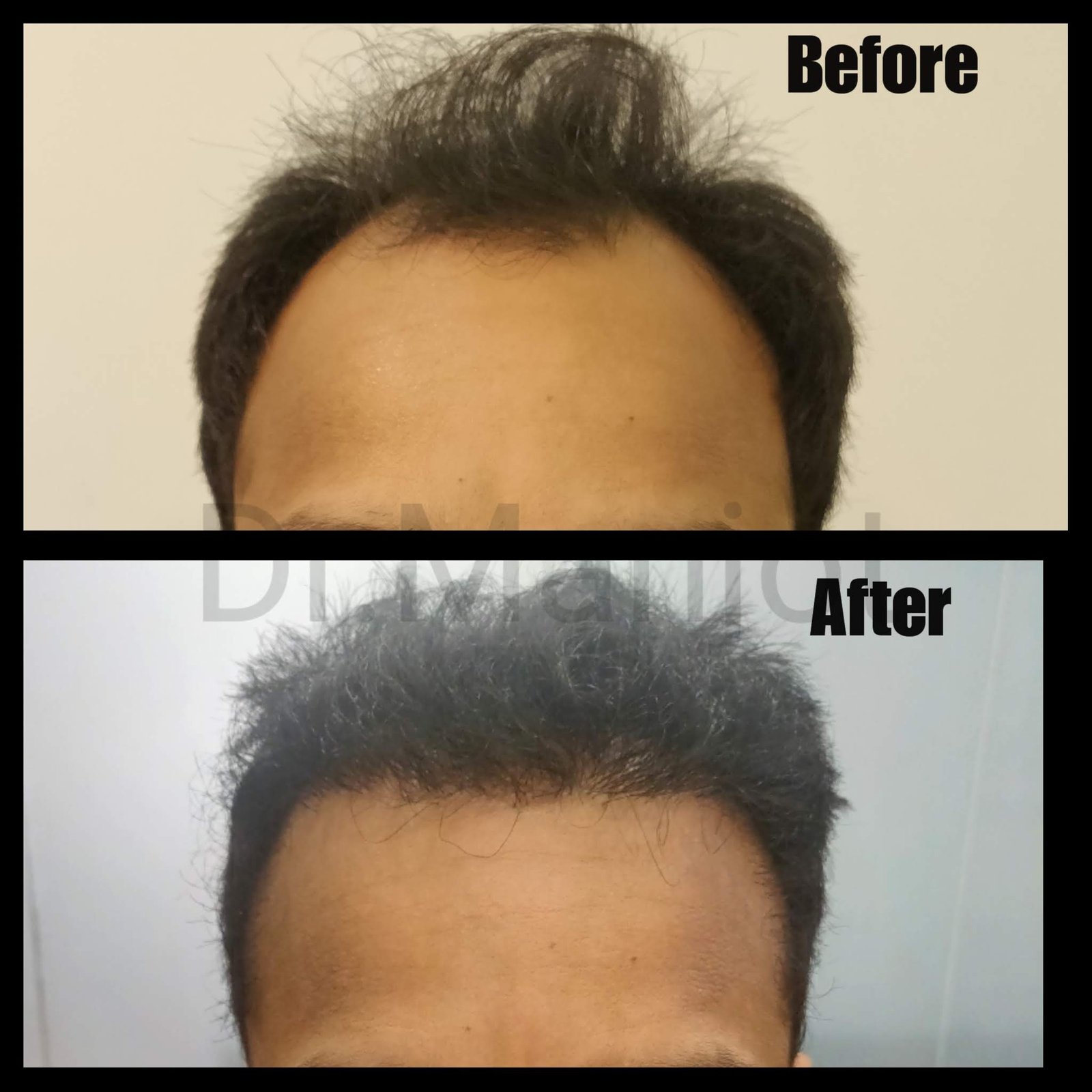 Hair-Transplant-3.jpg