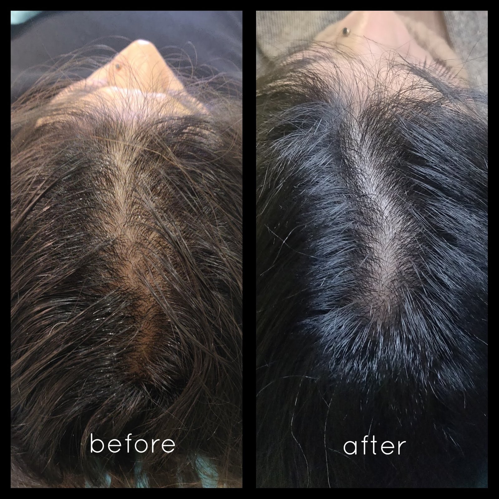 Hair-Transplant-5.jpg