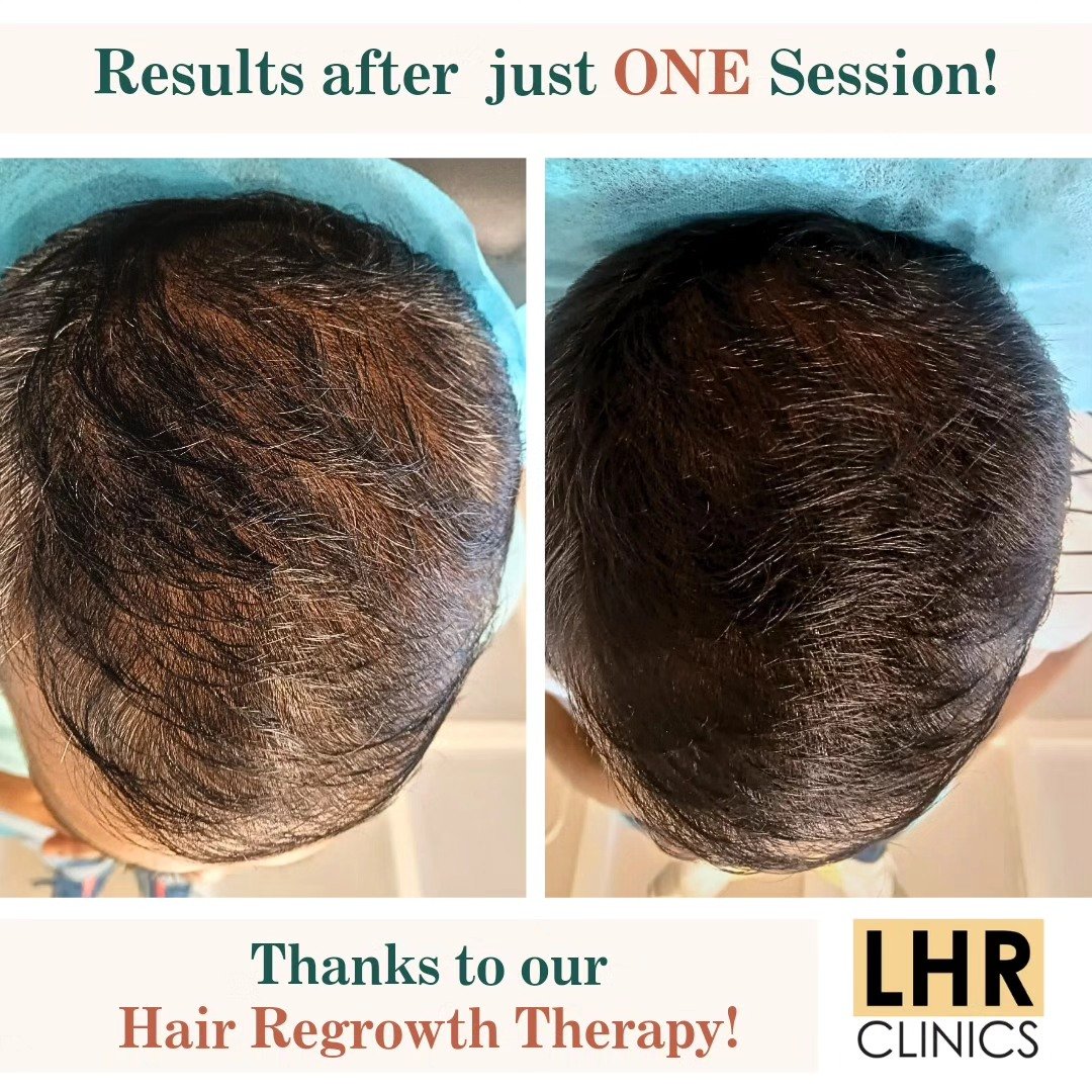 Imagine-seeing-your-hair-go-from-thin-to-full-after-just-ONE-session-–-thats-exactly-what-happe.jpg