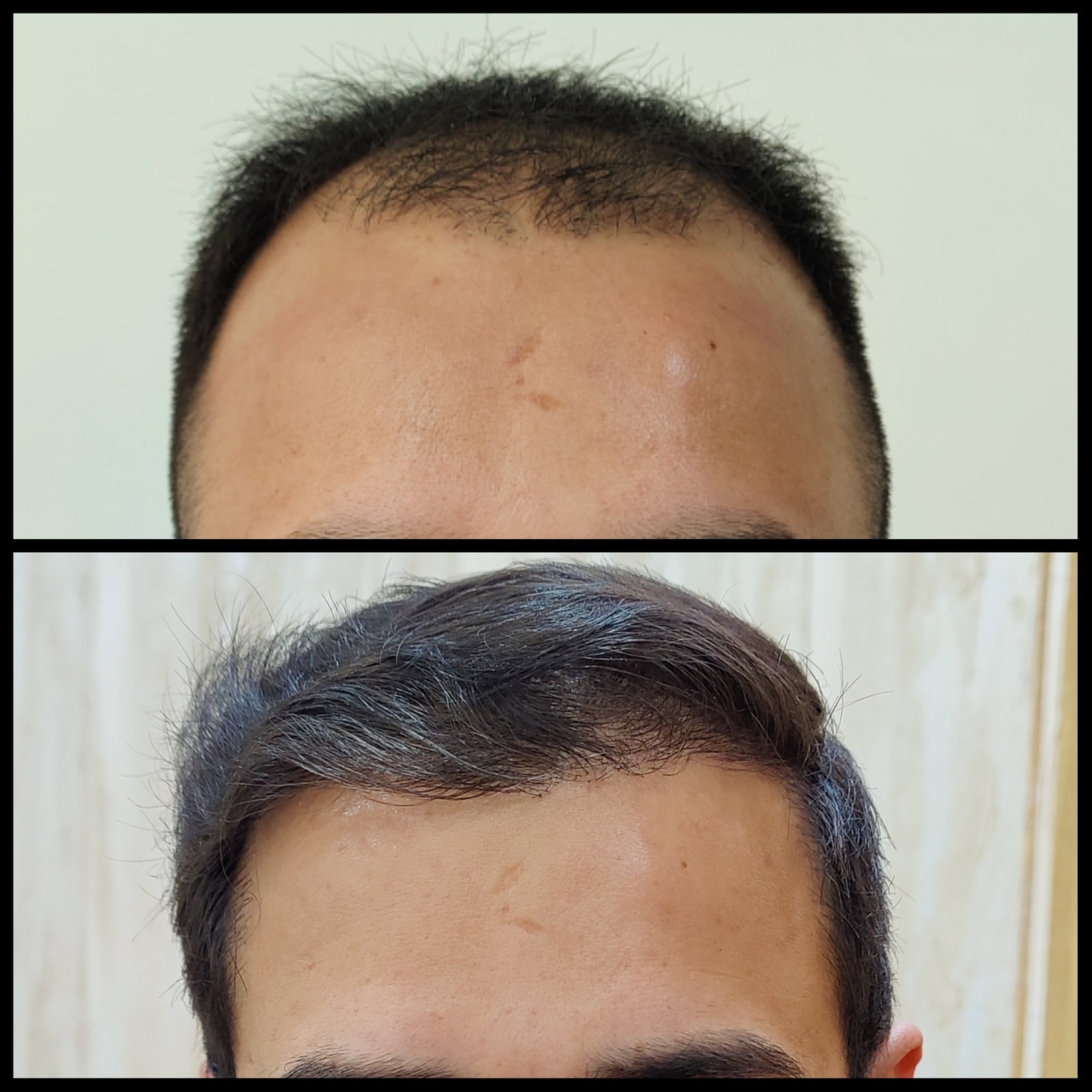 hair-Transplant-copy-2.jpg